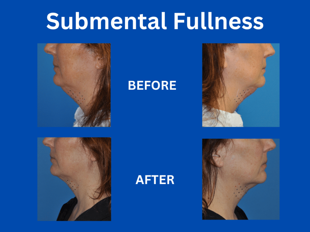 Submental Fullness: Before and After