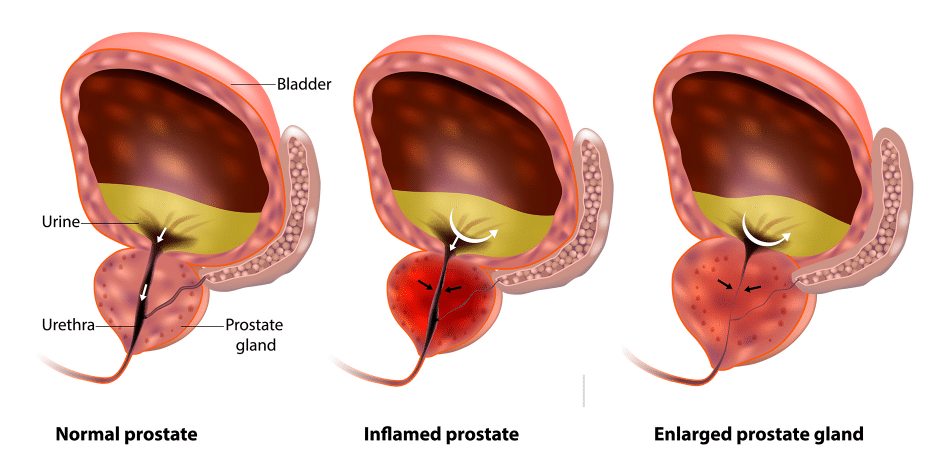 Men’s Health Alert: Benign Prostatic Hyperplasia (BPH)