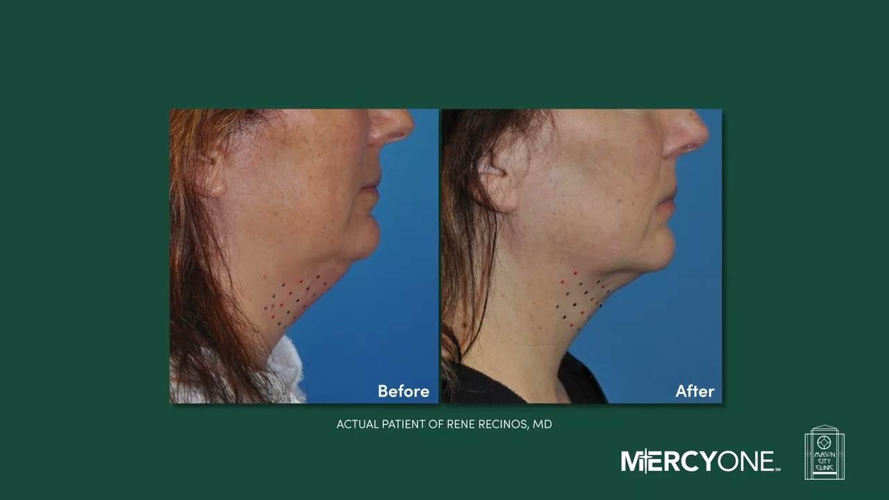 Minimally invasive procedure to reduce double chins — Rene Recinos, MD