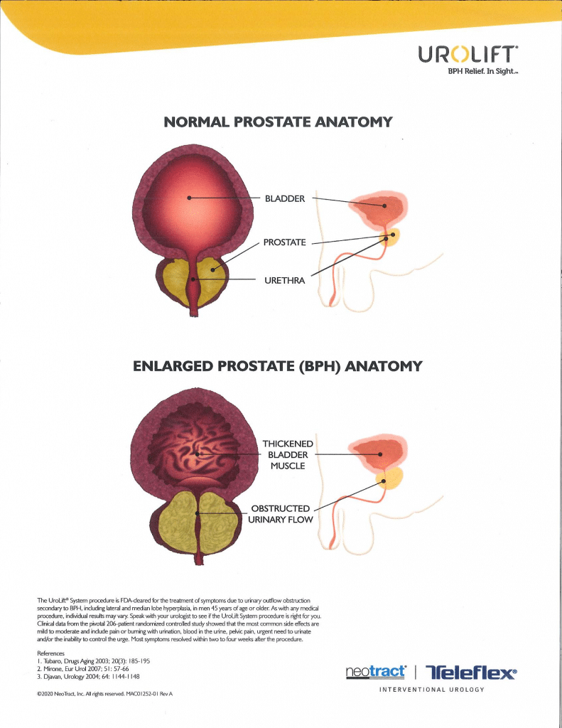 Enlarged vs normal prostate