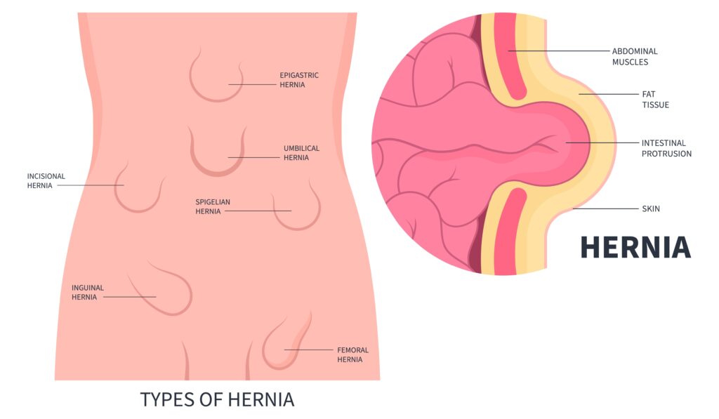 graphic illustrating the types of hernias