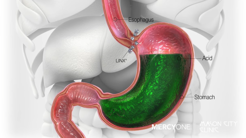 Medical illustration showing a cross-section of the digestive system with an esophagus, stomach, and magnetic device labeled as LINX. The device is placed around the esophagus to prevent acid reflux.