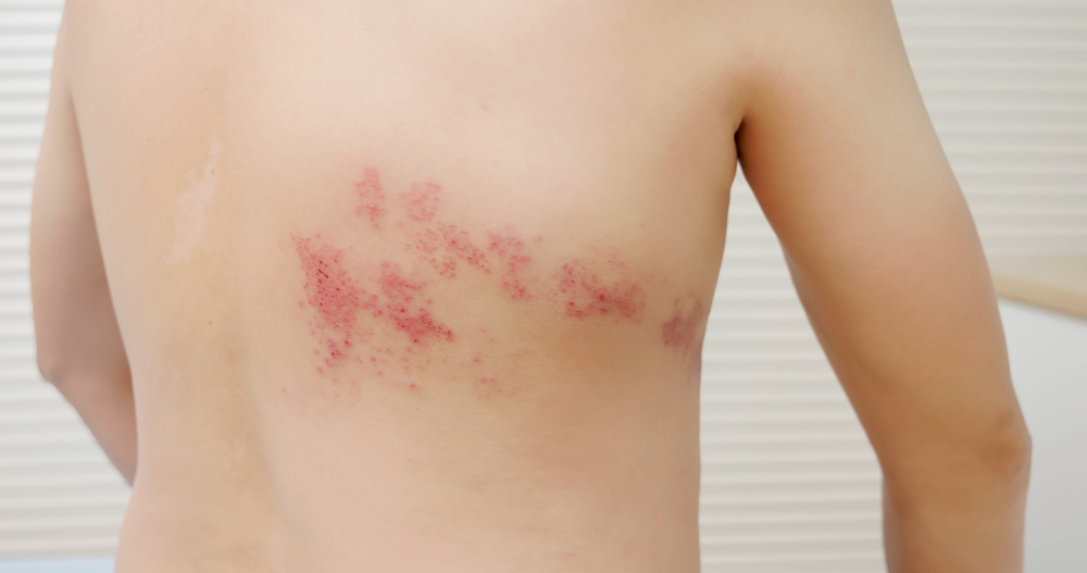 Close-up of a person's bare back showing a red, blistering rash spread across the skin, possibly indicating a skin condition such as shingles or dermatitis.
